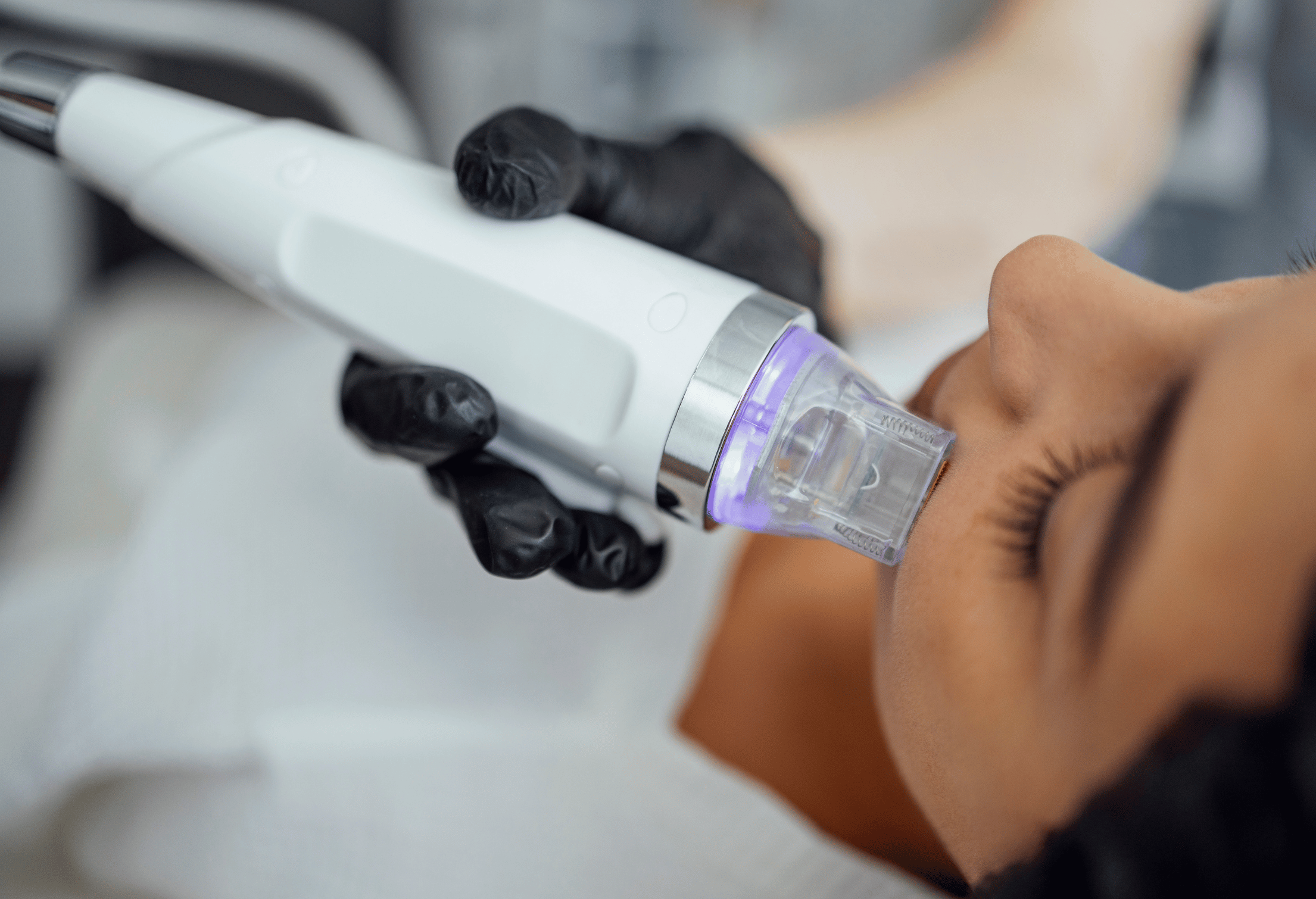 Radiofrequenz (RF) Microneedling