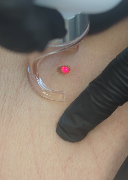 CO2 Laser Behandlung